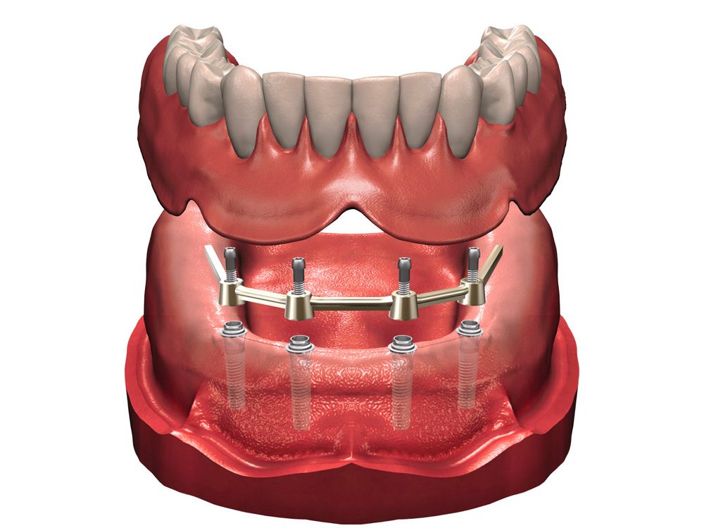 Prótesis Dentales en Plasencia